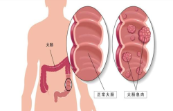 腸息肉會癌變嗎？腸鏡檢查出腸息肉千萬別大意！