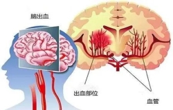 原來(lái)高血壓和腦出血有這樣的關(guān)系......高血壓別不當(dāng)回事，警惕變成腦出血！