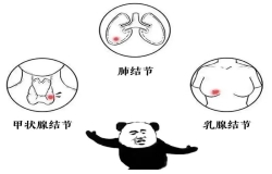 體檢查出結節(jié)，真的會癌變嗎？別慌，這樣處理就對了！